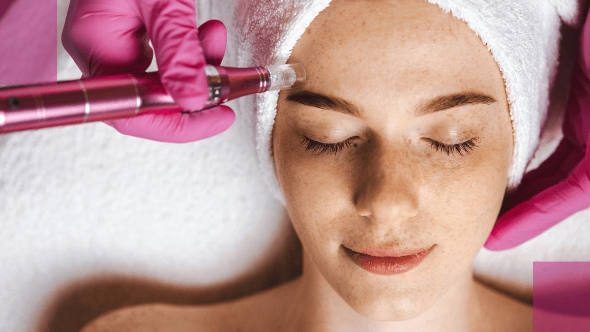 A client gets her first microneedling procedure done at her esthetician's office.