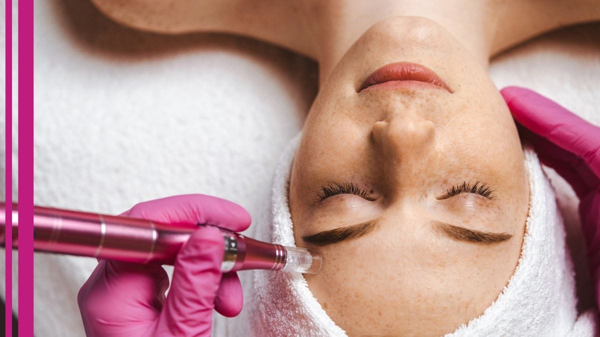 A client gets a microneedling treatment from her esthetician.