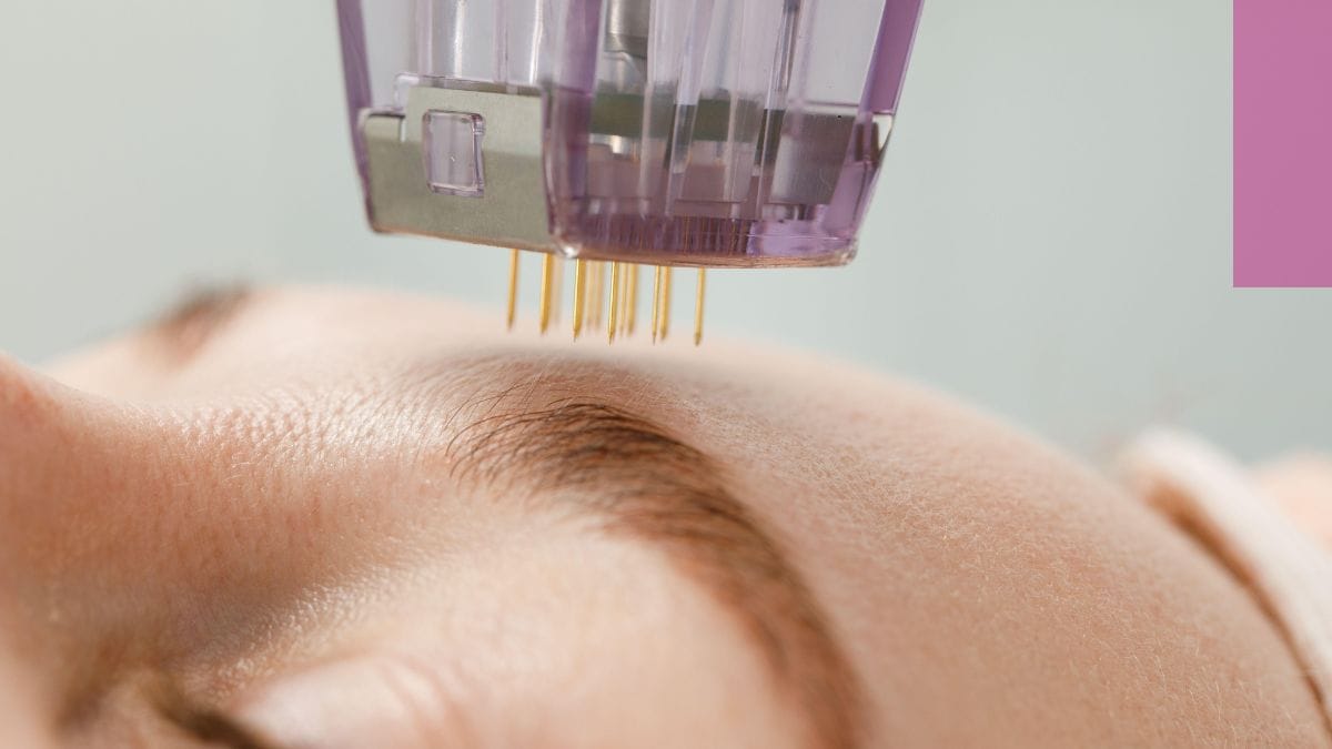 Esthetician provides a microneedling facial for her client during the summer.