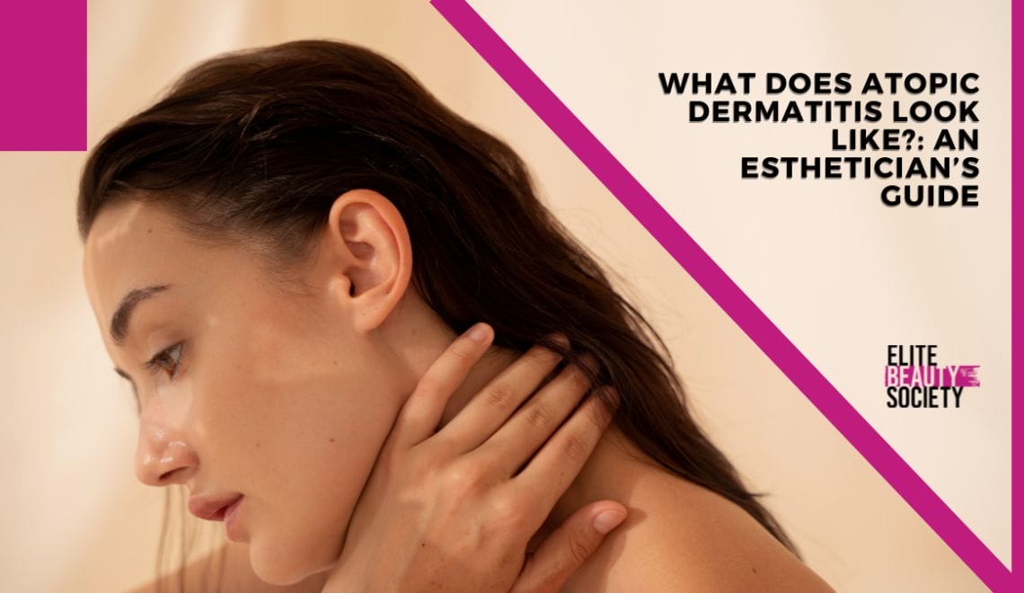What Does Atopic Dermatitis Look Like: Esthetician’s Guide
